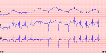 rythme cardiaque