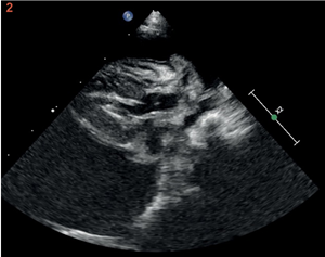 Image échocardiographique en abord parasternal droit