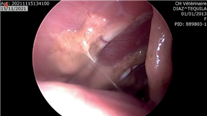 Vue thoraco-scopique permettant la visualisation de dépôts fibrineux et purulents sur la plèvre pariétale